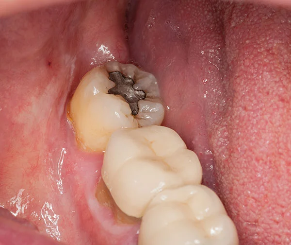 Dental Fillings Image
