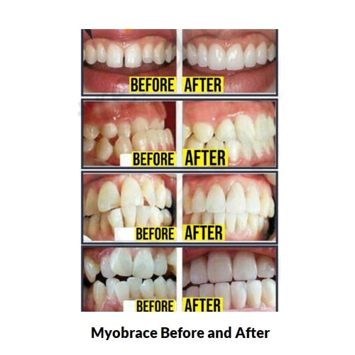 Myobrace Adults Before and After