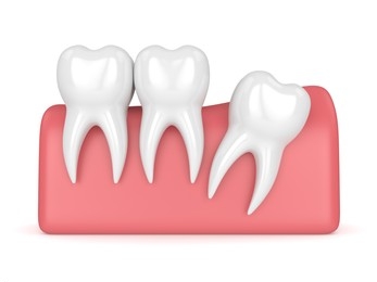 distal impaction wisdom tooth