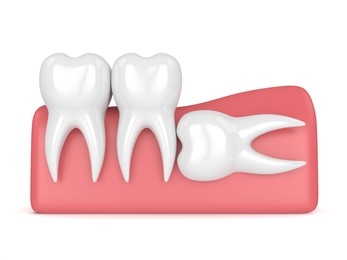 horizontal impaction wisdom tooth