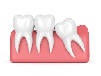 mesial impaction wisdom tooth
