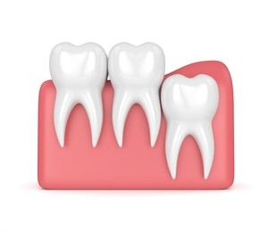 vertical impaction wisdom tooth